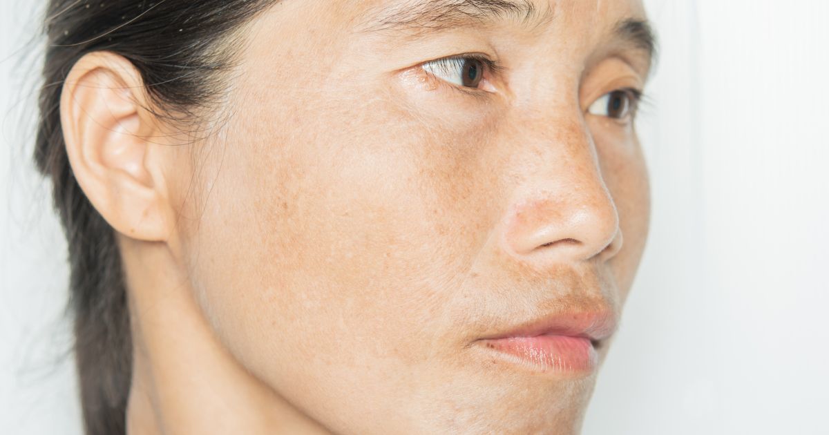 skincare for dullness of skin